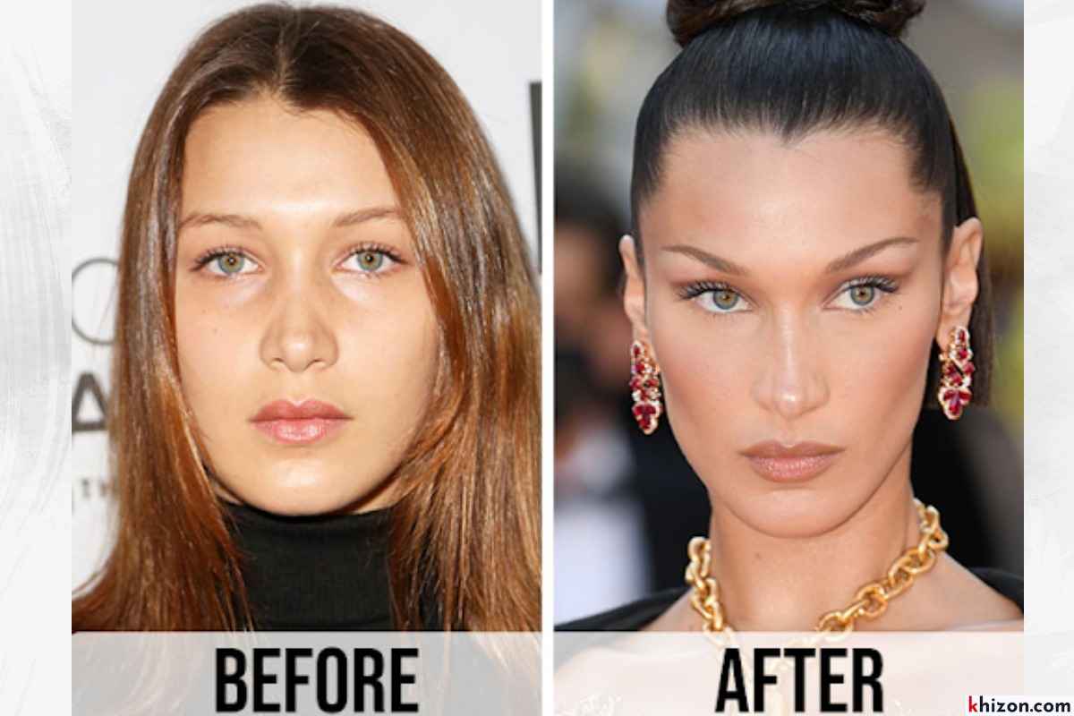 Celebrity Plastic Surgery Before and After